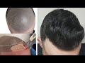 CASO ÚNICO - micropigmentación + injerto capilar // alopecia avanzada N-VI