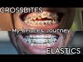 My braces Journey | ELASTICS &amp; CROSSBITES
