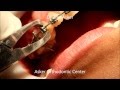 Bracket removal-Taking off braces-Removing orthodontic brackets By Dr.Amr Asker