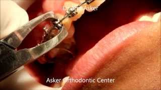 Bracket Removal-Taking Off Braces-Removing Orthodontic Brackets By Dr.amr Asker