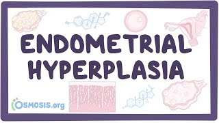 Endometrial hyperplasia - an Osmosis Preview