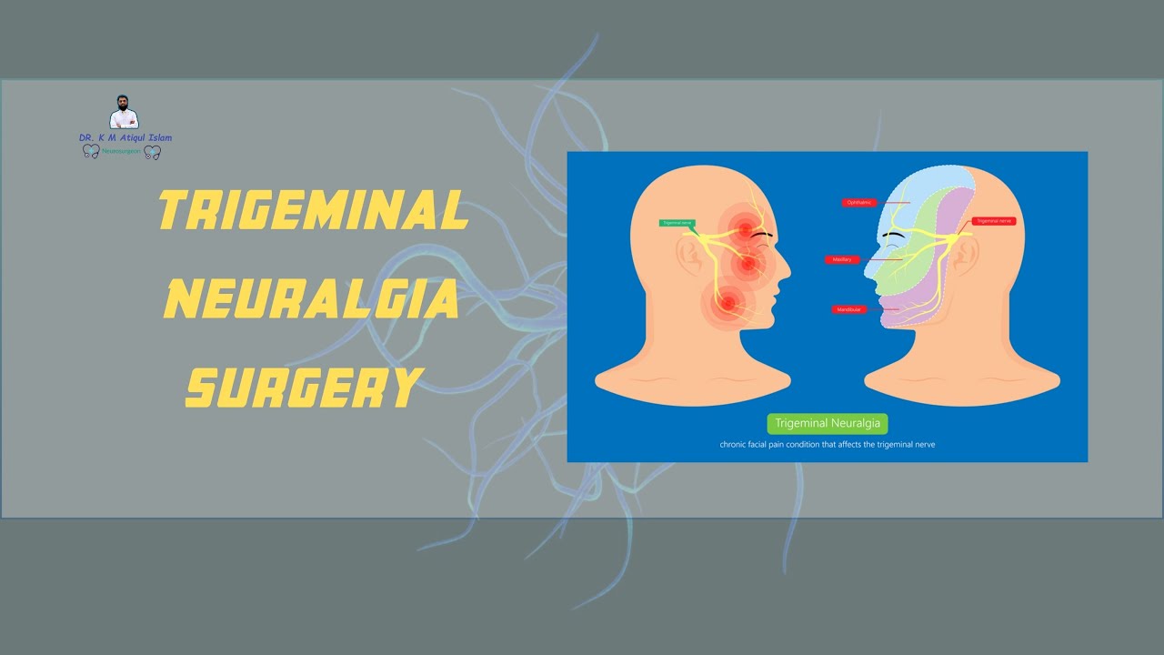 Trigeminal Neuralgia Surgery: Relieve Facial Pain Fast! - YouTube