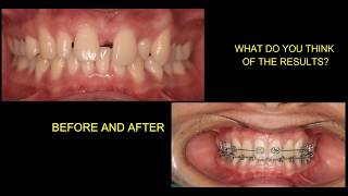 Esthetic Dental Restoration After Orthodontic Treatment - Multidisciplinary Orthodontics