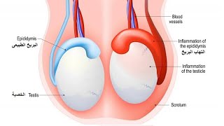 2020 07 31- ألتهاب البربخ   أجابة أسئلة المتابعين