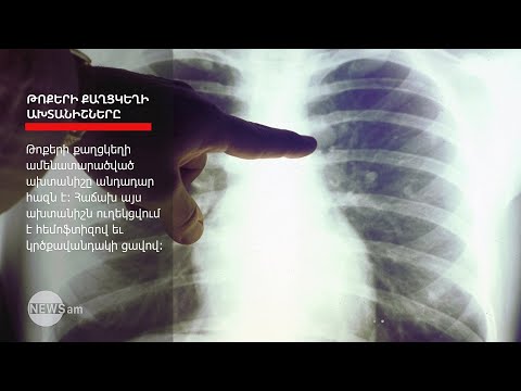 Video: Որտե՞ղ է թոքերի միջաստեղային հատվածը: