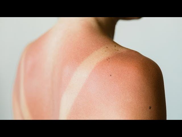 How To Treat Sunburn At Home | Rachael