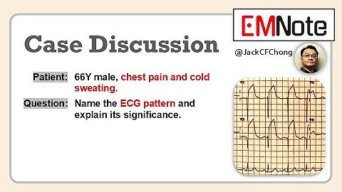 STEMI with Tombstone Pattern ECG