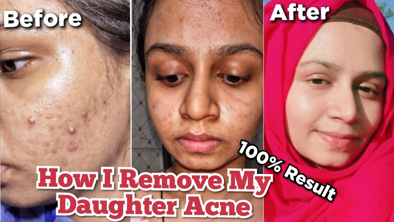 How I Remove My Daughter Acne Best Remedy for Acne prone skin