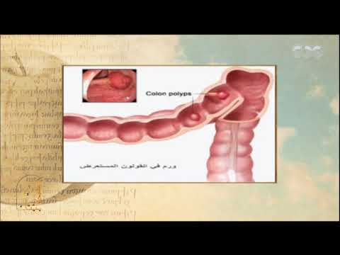 الحكيم في بيتك | هل مريض سرطان القولون ممكن يخف من خلال العلاج الكيماوي فقط بدون الاستئصال؟