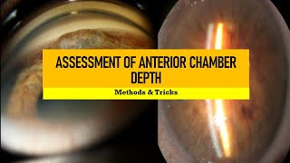 ANGLE DEPTH ASSESSMENT and GRADING | Van Herrick, smith, pen torch, limbal split technique and more