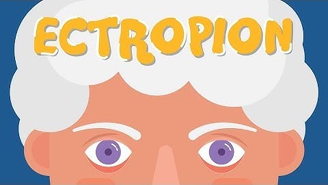 What is Ectropion?