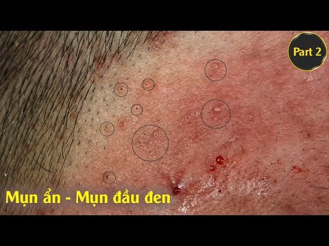 Điều trị mụn ẩn - mụn đầu đen hiệu quả uy tín. Tại Hiền Vân Spa |Part 2| bài 198