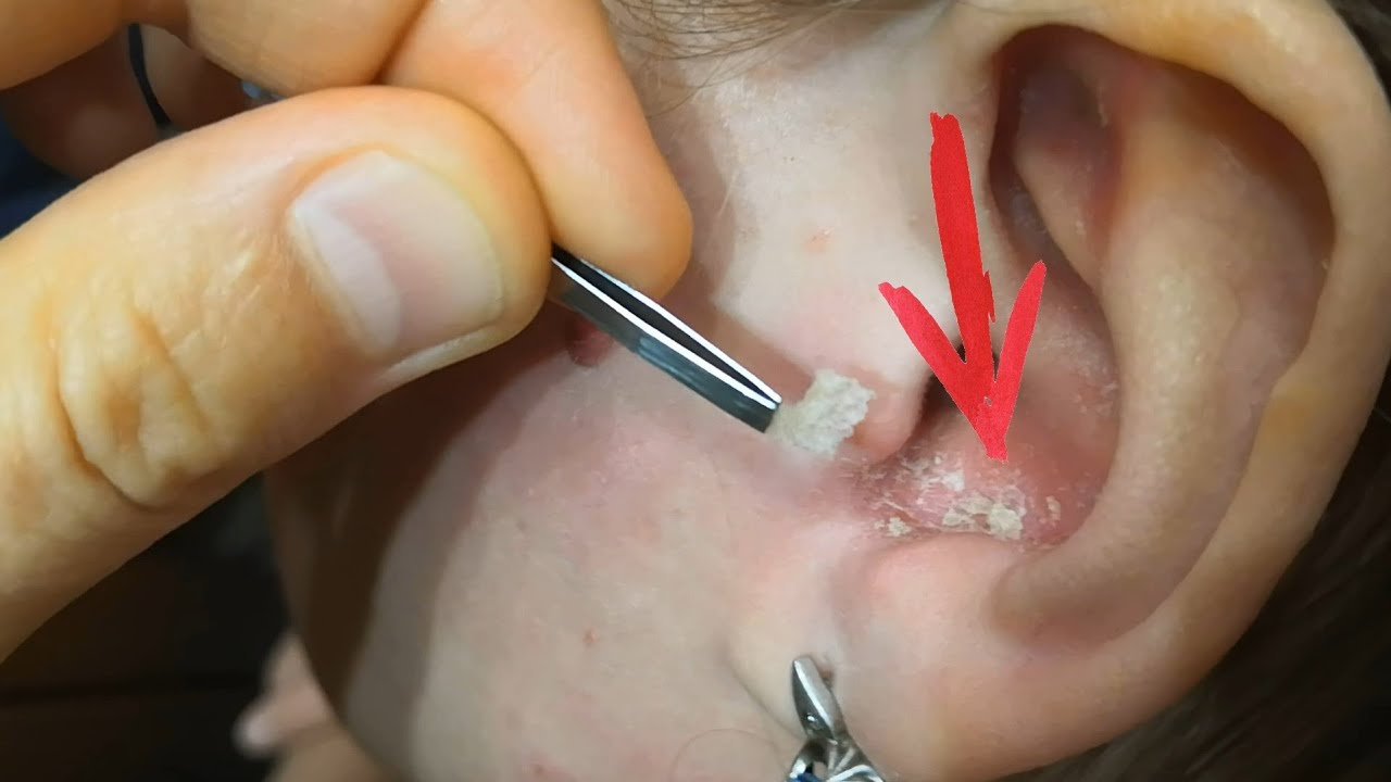 Psoriasis flakes in ear