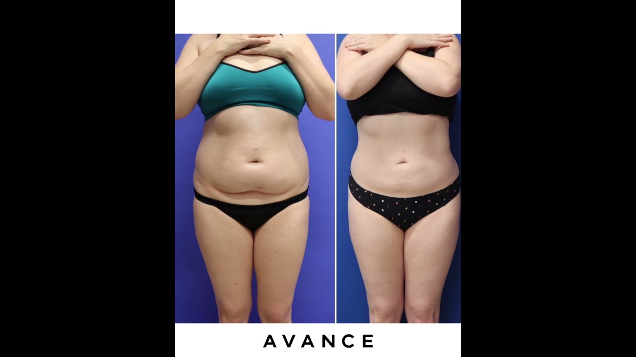 BodyTite Skin Tightening Radiofrequency with 360 Liposuction I Dr. Erez Dayan Reno, NV | Lake Tahoe