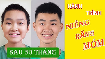Quá trình niềng răng móm (khớp cắn ngược) siêu nặng