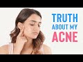 The truth about my acne  how i got rid of it  skincare routine for hormonal acne