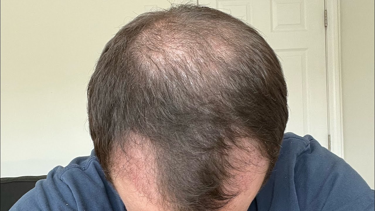Day 60 - 2 Month Results - FUE Hair Transplant - Reflecting On My Trip And  Healing Process - YouTube