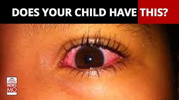 ‘Arcturus,’ A Highly Transmissible Covid Variant Has A New Symptom. Here’s What You Need To Know