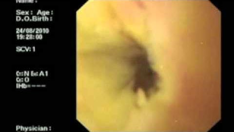 Habib EndoHPB - Endoscopic Intraductal RF Ablation of Cholangiocarcinoma by Dr. Nagy Reddy
