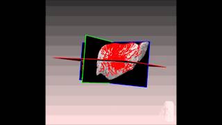Brain vessels segmentation and visuallization.