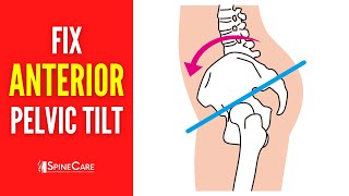 How to Fix Your Anterior Pelvic Tilt | STEP-BY-STEP Guide