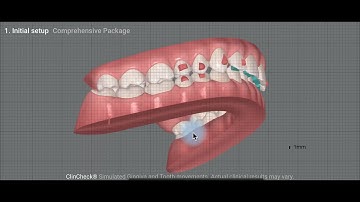 Invisalign - Class II Deep Bite Case