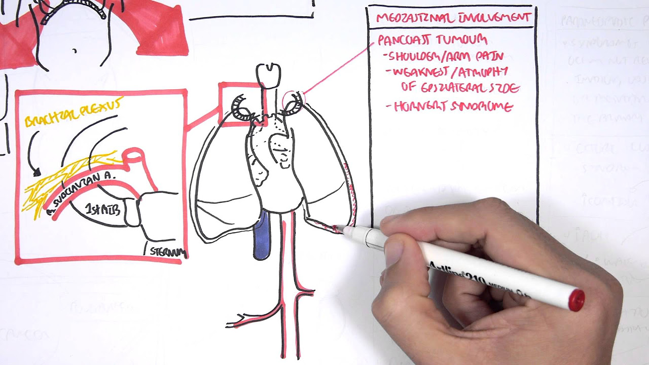 Lung Procedure Cleans Airways for Easy Breathing