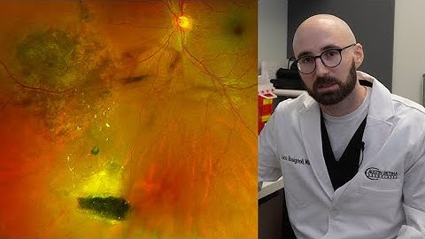 October 2025 Image of the Month | Large Foreign Body Embedded in Retina | Austin Retina Associates