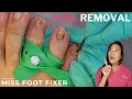 Damaged Nail Gently Removed | Expert Nail Extraction Procedure