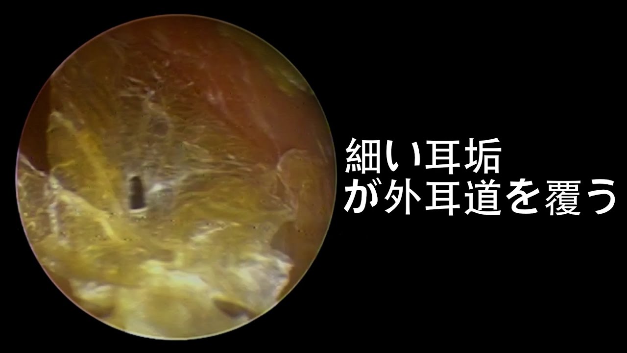 thin ear wax cover the ear canal YouTube thin ear wax cover the ear canal YouTube