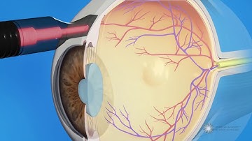 CPC for Glaucoma Treatment