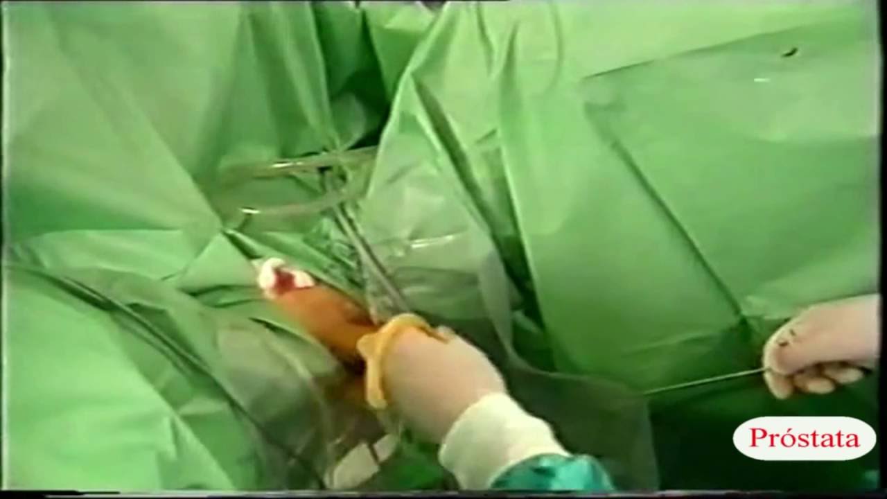 consecuencias adenoma de próstata consecuencias adenoma de próstata