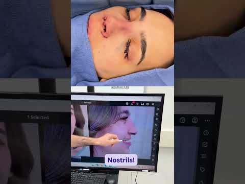 Video thumbnail: How is a  Deviated Nose Reshaped | Intra Operation Rome | From Crooked To Balanced! · Ali Sajjadian