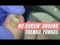 YEARS OF TOENAIL FUNGUS? ***DON'T WAIT TO TRY THESE TIPS!