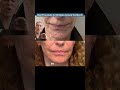Best Procedure for Wrinkles Around the Mouth