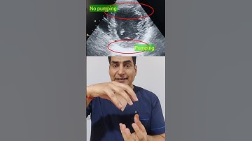 How to diagnose heart attack by echo l इको से हार्ट अटैक का पता कैसे लगाएं #echo #shorts