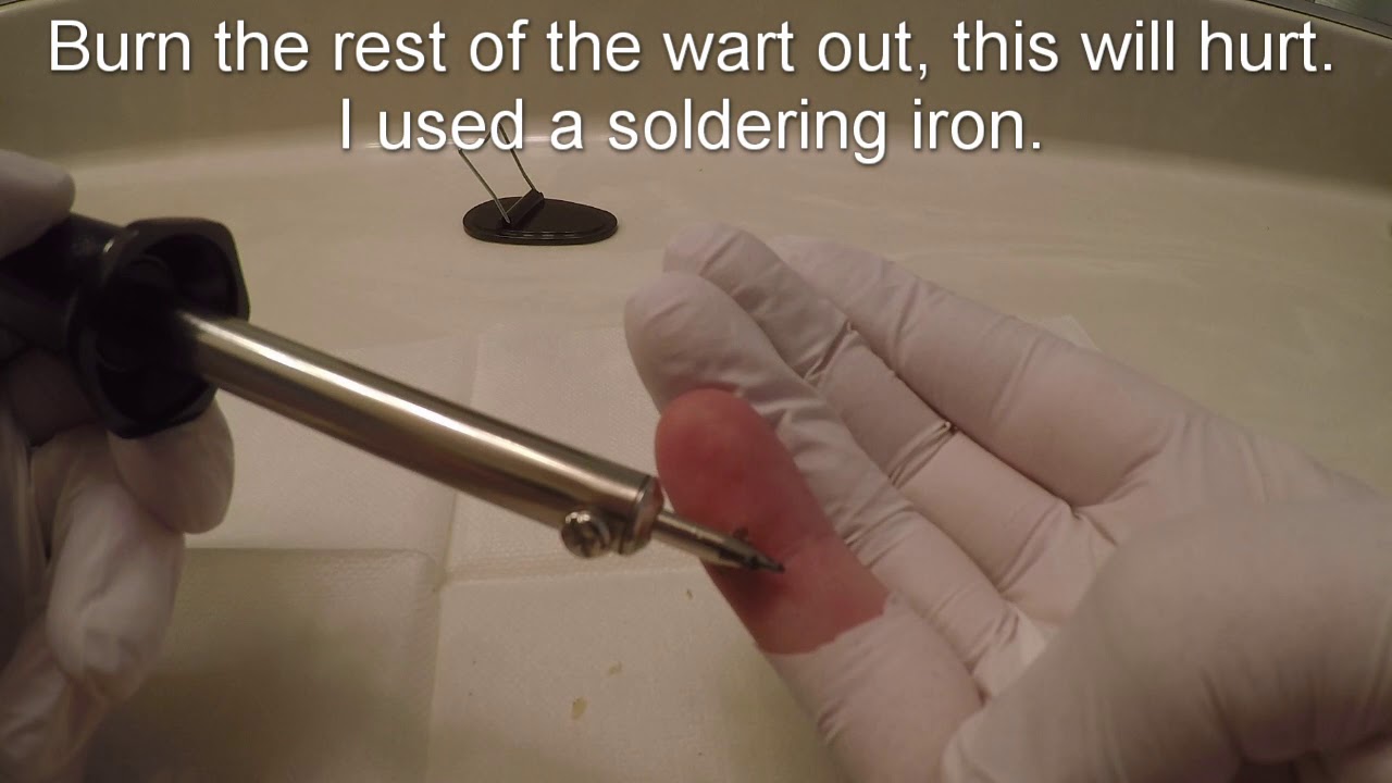 DIY wart removal YouTube DIY wart removal YouTube