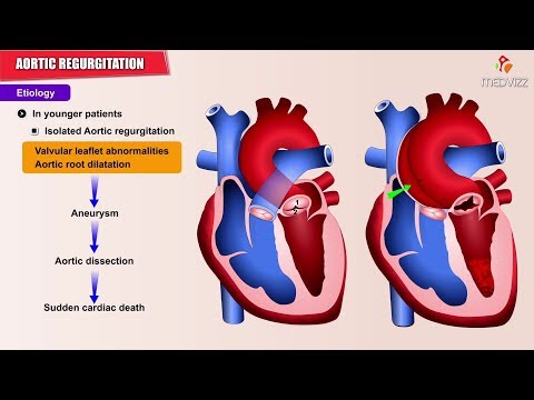 Video: Aortic Valve Insufficiency - Treatment, Degree