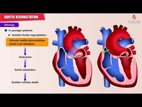 Aortic regurgitation / Aortic insufficiency : ایٹولوجی، پیتھالوجی، تشخیص اور علاج- USMLE