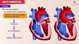 Aortic regurgitation / Aortic insufficiency : Etiology , Pathology , Diagnosis  and Treatment USMLE
