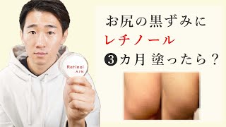 お尻の黒ずみにレチノールA1%クリームを３か月塗り続けた結果。【色素沈着の治し方】