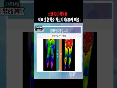이동엽원장의 신경풍선확장술로 척추관 협착증 치료사례(80세 여성)