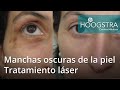 DiscusióN Manchas Oscuras DespuéS Del LáSer Nuevo