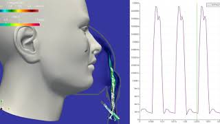 Vector field using #CFD for #COVID_19 Free Respirator Mask With Venturi's valve #virtualflow