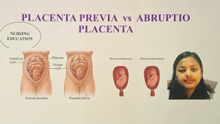 PLACENTA PREVIA VS ABRUPTIO PLACENTA FOR NCLEX EXAM AND NURSES |USRN |USNURSE Guide
