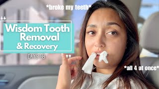 Getting all 4 of my wisdom teeth removed *PAINFUL* | Recovery days 1-8