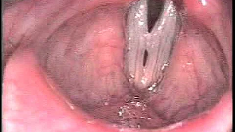 Stroboscopy: Variety of vocal cord polyps - DayDayNews