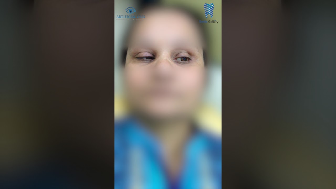 Artificial Eye Movement (Patient's Left Eye) compared to Natural Eye