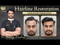 Transformative hairline restoration case study hair transplant before after results  medlinks