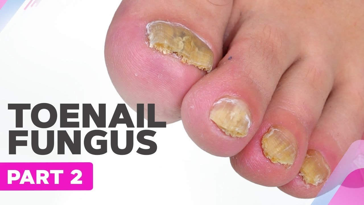 How To Prevent And Treat Your Baby's Ingrown Toenails - MVS Podiatry  Associates